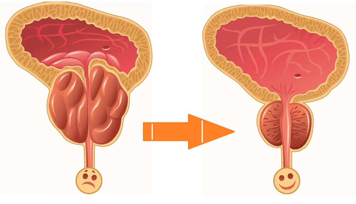 Wpływ Uromexil Forte na prostatę z zapaleniem gruczołu krokowego i gruczolakiem